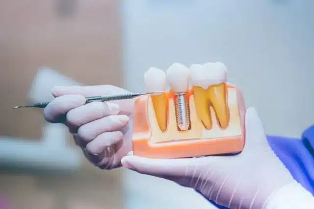 Dental implants