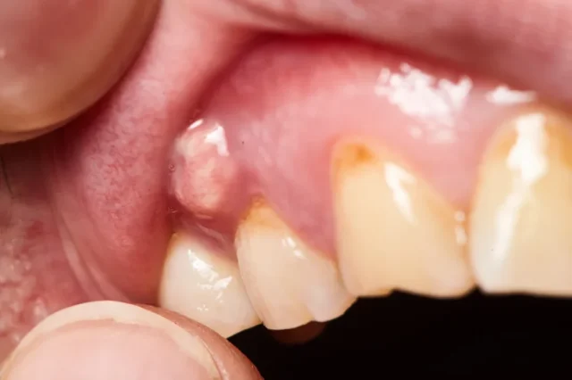 Oral surgery abccess treatment