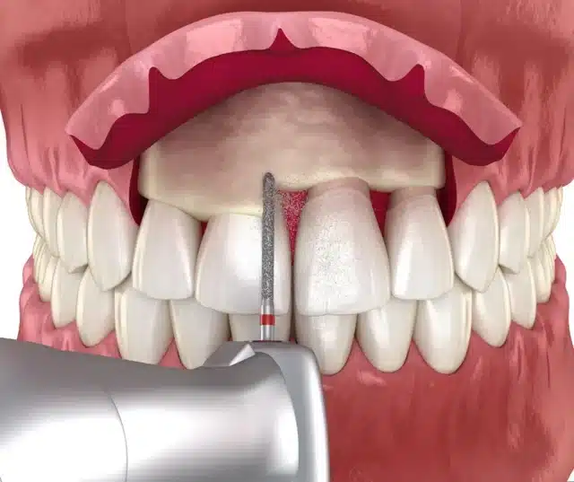 Oral surgery crown lengthing