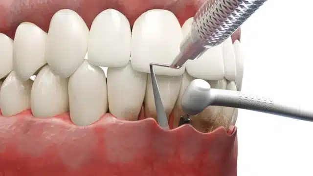 Oral surgery pocket reduction