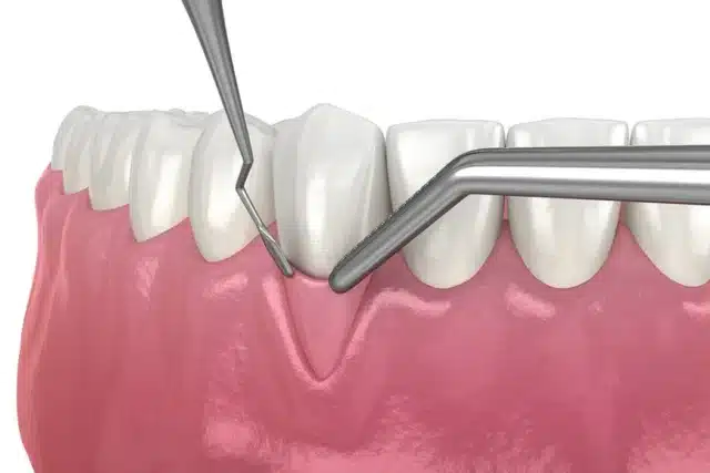 Oral surgery soft tissue grafting